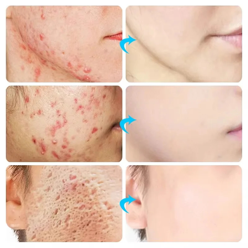 كريم حب الشباب للوجه، علاج لإز - مراجعة Korean Skincare Routine وسعره